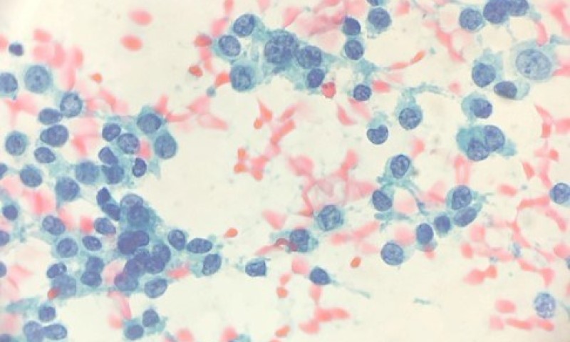 June 24 Case Study - Unusual Finding in a Suspected Haematoma of Breast
