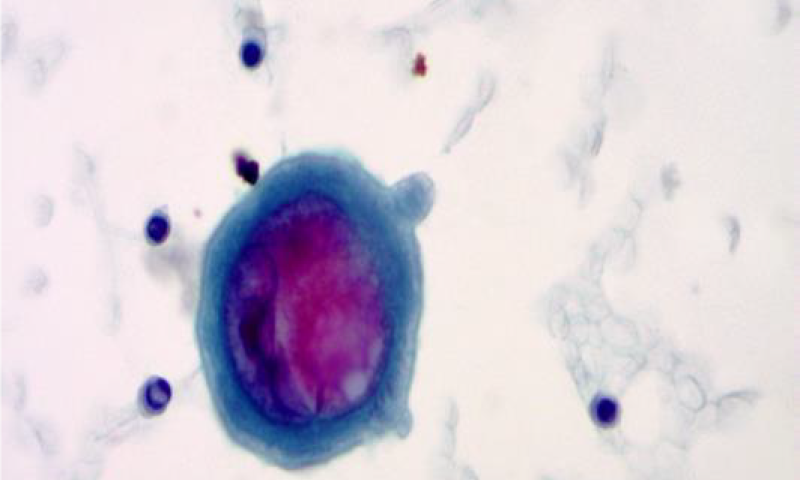 February Case Study 2025 - Dual pathology in a pleural fluid