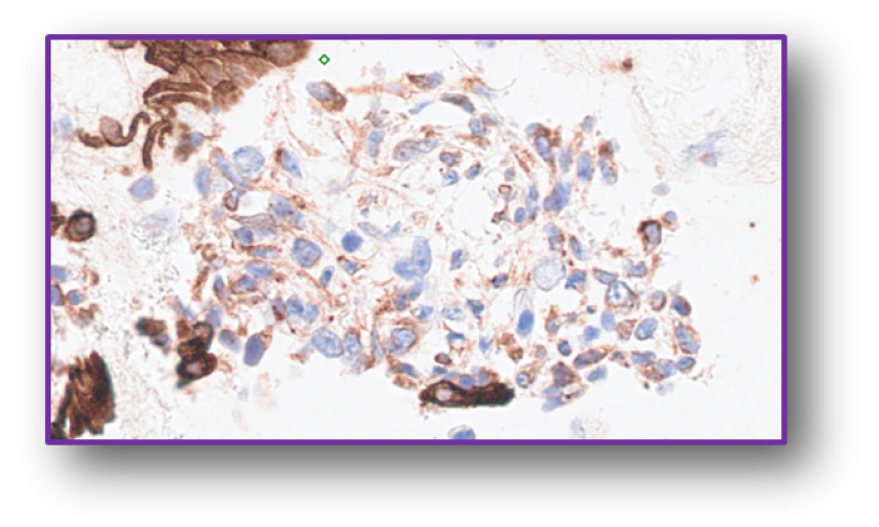 October 2024 Case Study - Bronchial cytology showing squamous cell carcinoma with unusual morphology