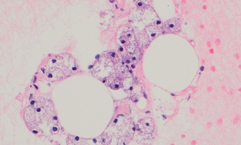 December 2024 Case Study - Acinic Cell Carcinoma with high grade transformation and lung metastasis 