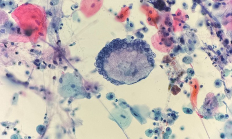 Bronchial washing Langhans cell