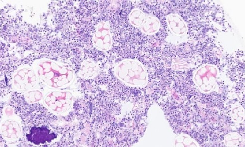 Pulse granulomas in lung tissue due to aspiration